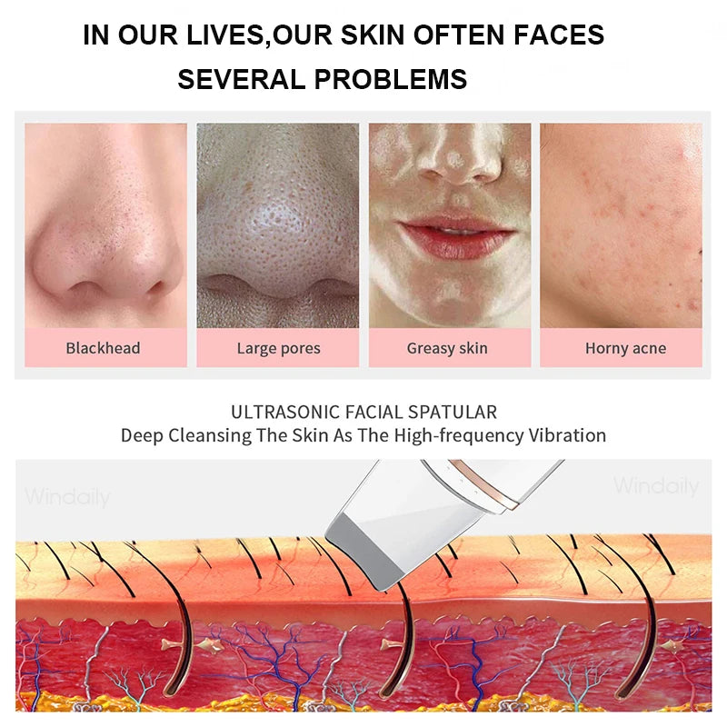 Épurateur de peau à ultrasons, spatule vibrante pour le visage, dissolvant de points noirs, pelle propre, Peeling par Cavitation, Lifting du visage, outils de soins de la peau